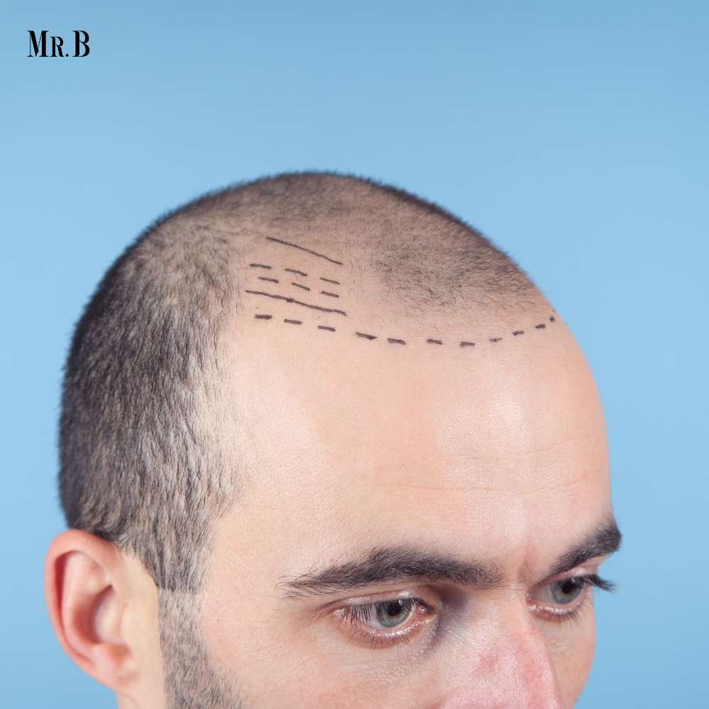 What is the Hair Transplant Cost in the US? | Mr. Business Magazine