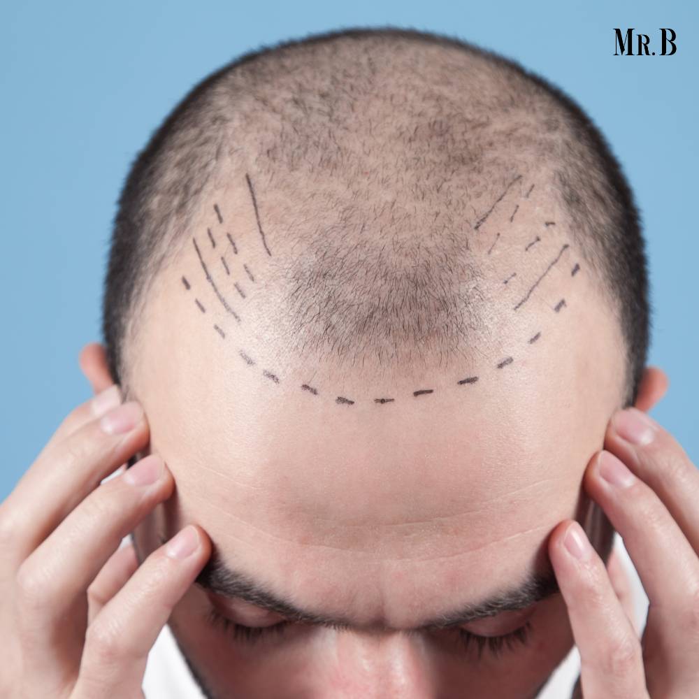 Understanding Hair Planting Cost: Guide to Hair Restoration | Mr.Business Magazine